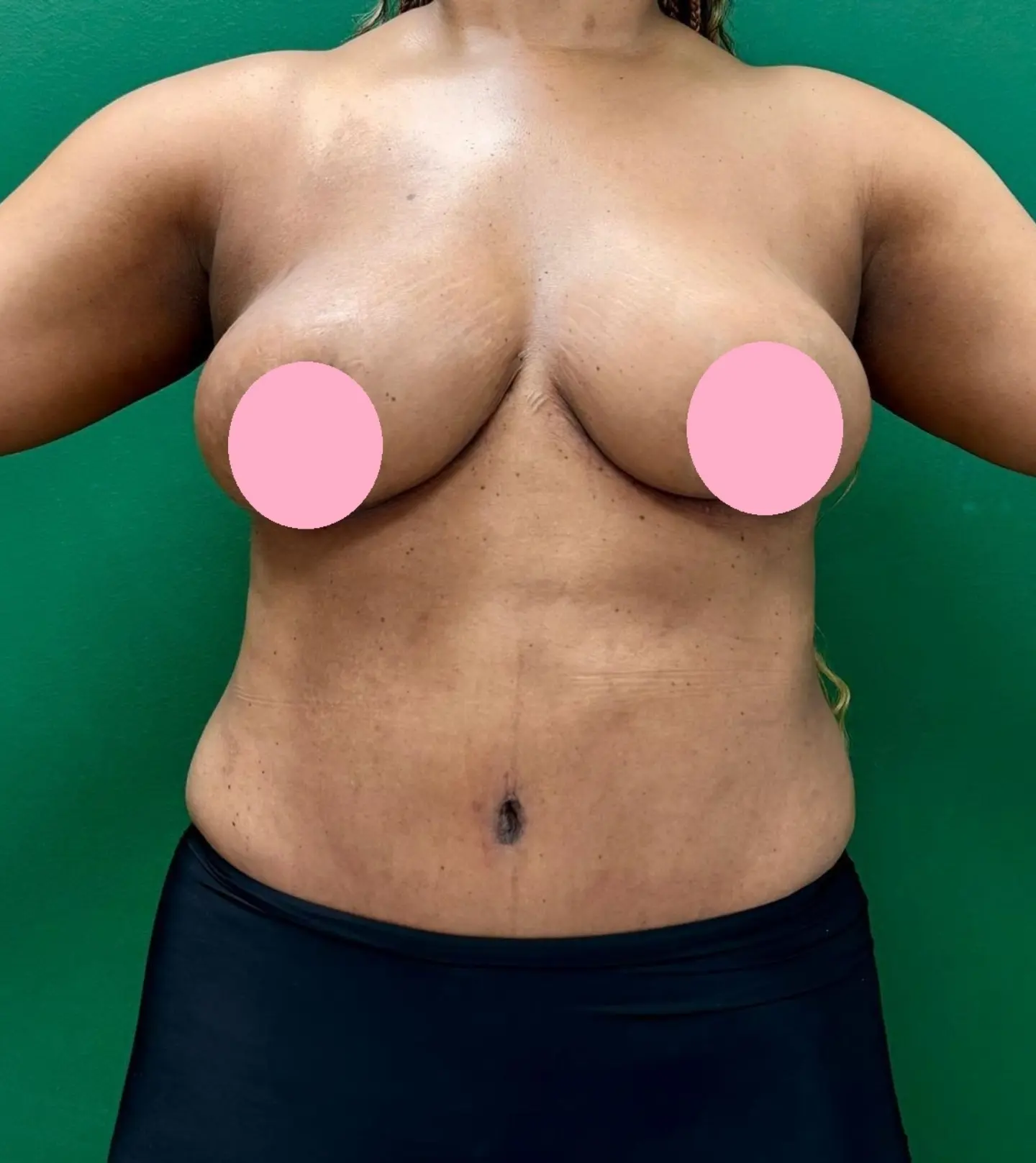 Breast Reduction After